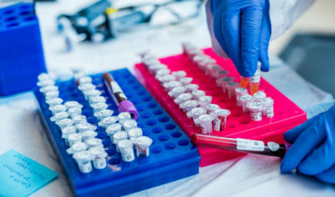 Blood Test May Help Confirm Parkinson's Diagnosis