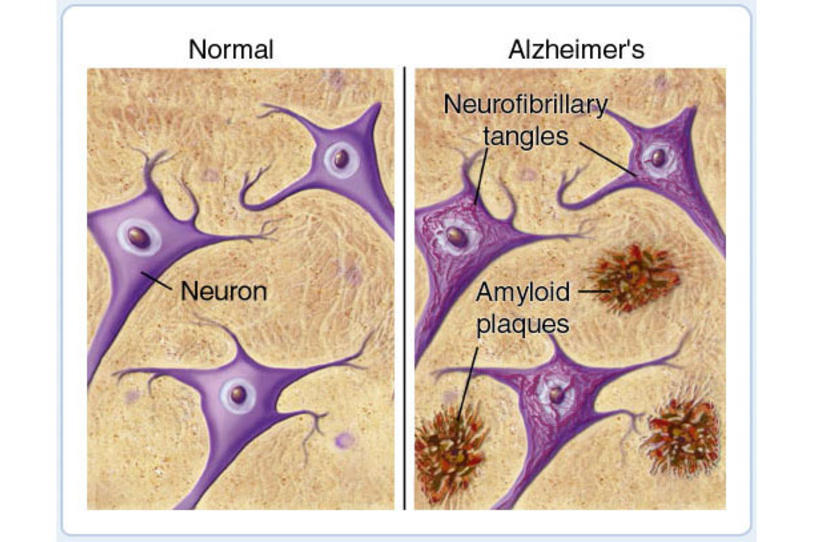 Resurrecting Tau in the Search for an Alzheimer’s (and Potentially, Parkinson’s) Cure